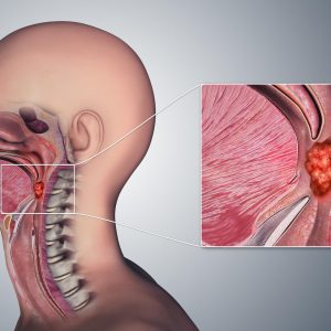 Anal sex now linked to increased rate of throat cancer : Dr Hisham Mehanna