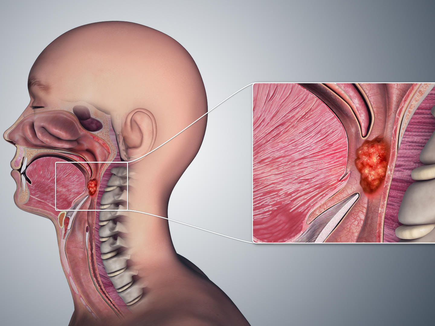 Anal sex now linked to increased rate of throat cancer : Dr Hisham Mehanna -